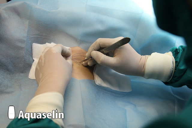 Phẫu thuật cắt tuyến mồ hôi vùng nách